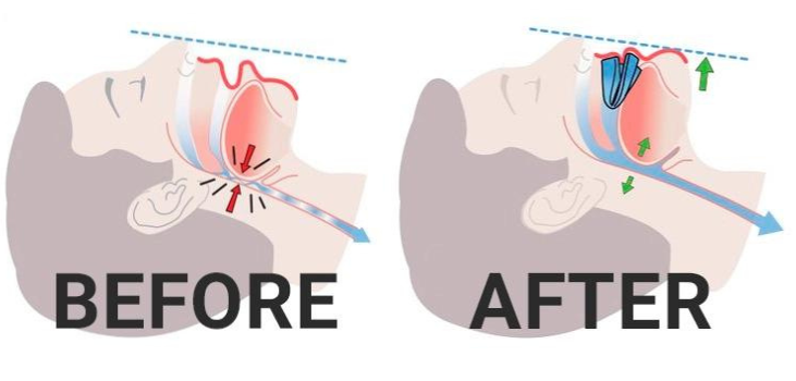 ZQuiet anti snoring mouthguard figure before after the use